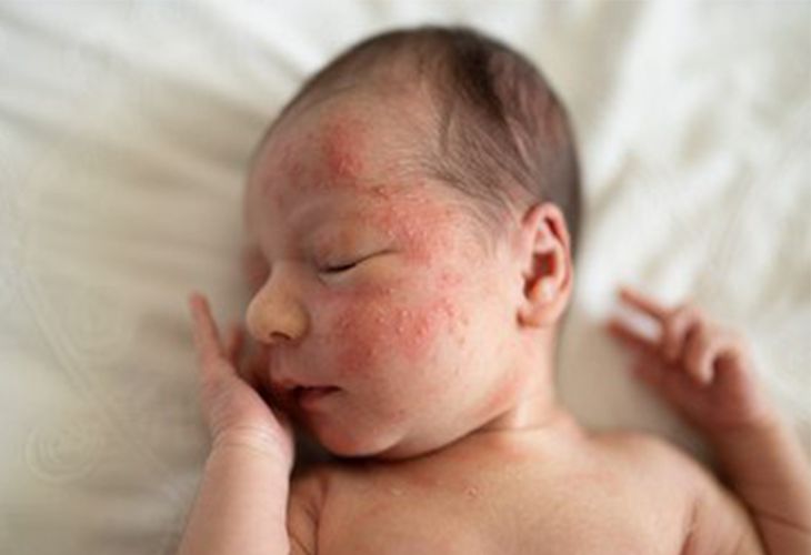 علل مشکلات پوستی در نوزادان